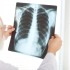 TUBERCULOSE