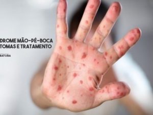 Viep alerta sobre sintomas e tratamento em casos de Síndrome Mão-Pé-Boca